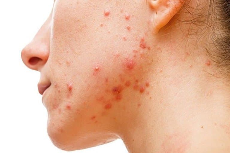 Những lưu ý khi điều trị mụn trứng cá