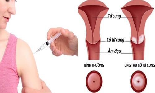 Ý nghĩa của kết quả xét nghiệm Pap