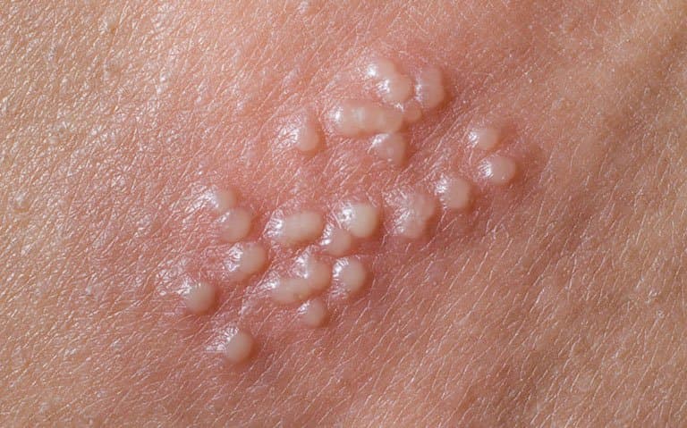 Herpes sinh dục và căng thẳng thần kinh stress