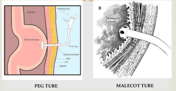 Mở thông dạ dày qua da dưới X-quang tăng sáng