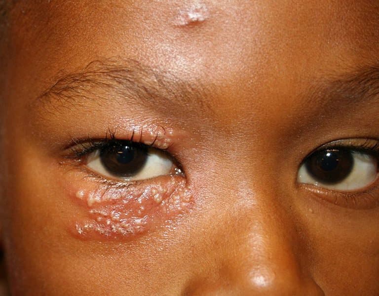 Những biến chứng nguy hiểm của bệnh zona thần kinh