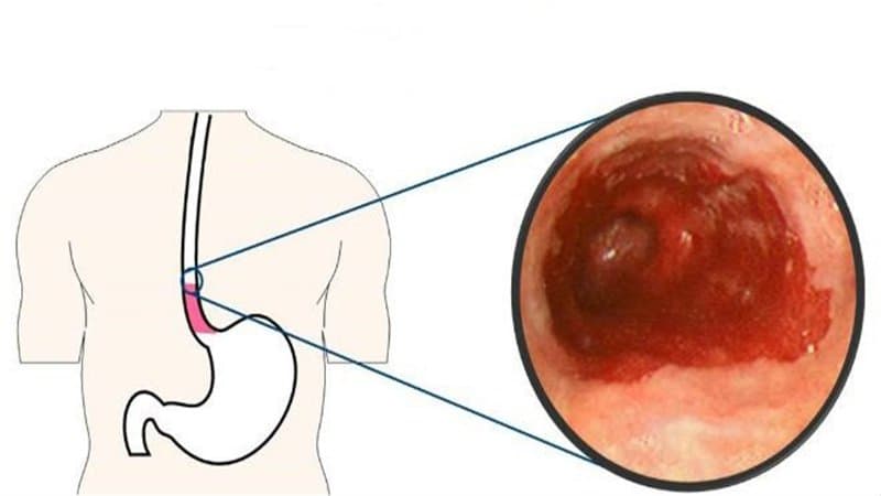 Điều trị hẹp miệng nối thực quản sau phẫu thuật