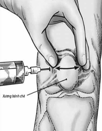 Tiêm corticoid vào khớp có hại gì? và Những điều cần lưu ý
