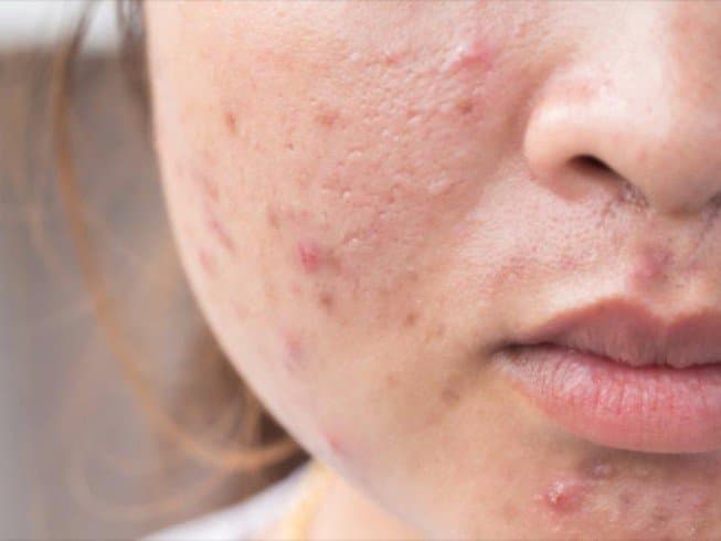 Có thể dùng kháng sinh điều trị mụn trứng cá không? và thời gian bao lâu?