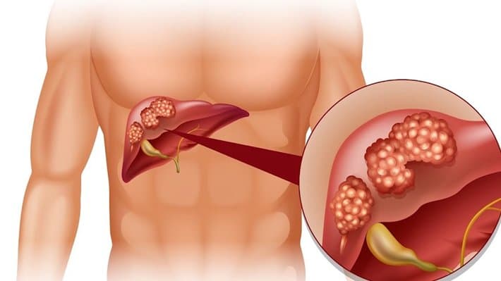 Viêm gan B là bệnh gì? Xét nghiệm máu chẩn đoán Viêm gan B