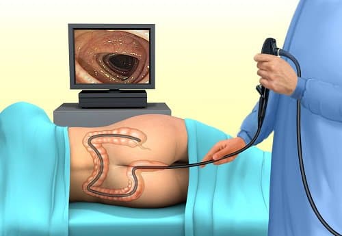 Nội soi đại tràng có gây ra biến chứng không?