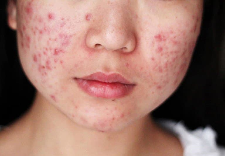 Thế nào là mụn trứng cá?, Các loại mụn trứng cá, Nguyên nhân và Cách phòng tránh