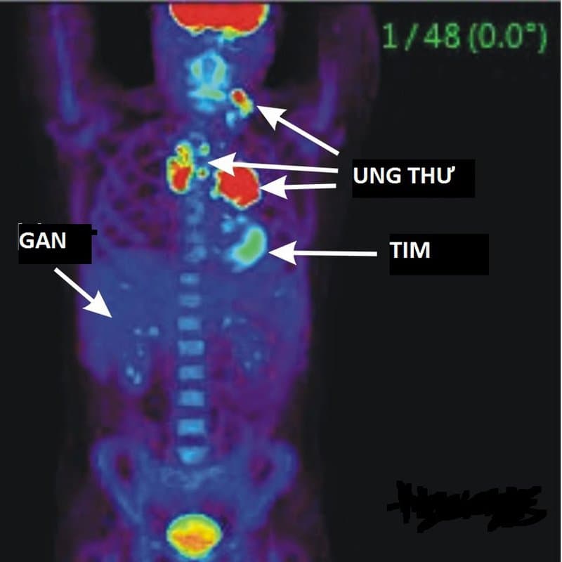 Chụp PET/CT: Mục đích và kỳ vọng