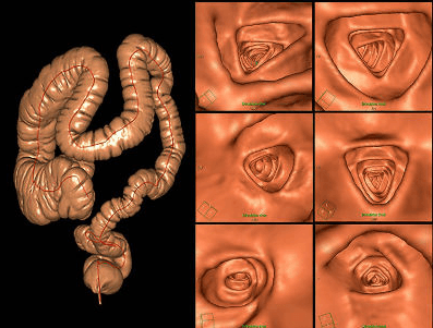 Quy trình kỹ thuật chụp CT đại tràng có nội soi ảo