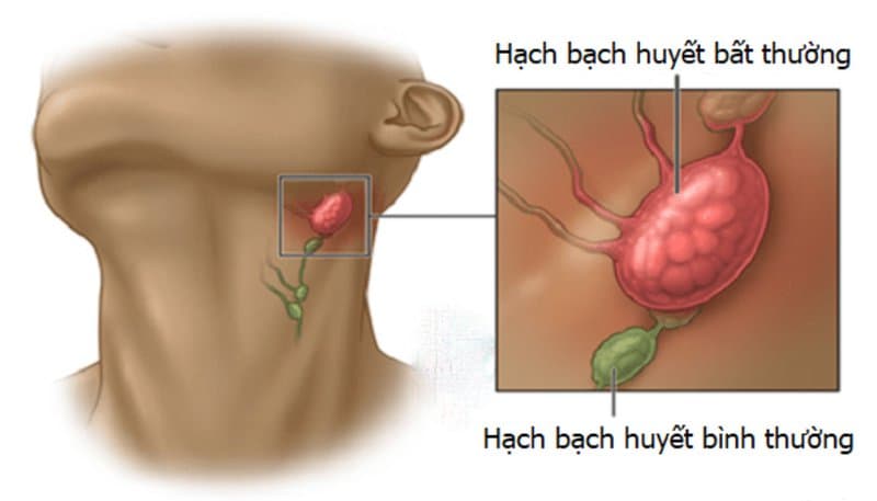 Quy trình chụp cộng hưởng từ bạch mạch có tiêm thuốc đối quang từ đặc hiệu