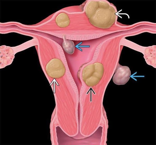 Gây mê nội khí quản phẫu thuật nội soi bóc u xơ tử cung