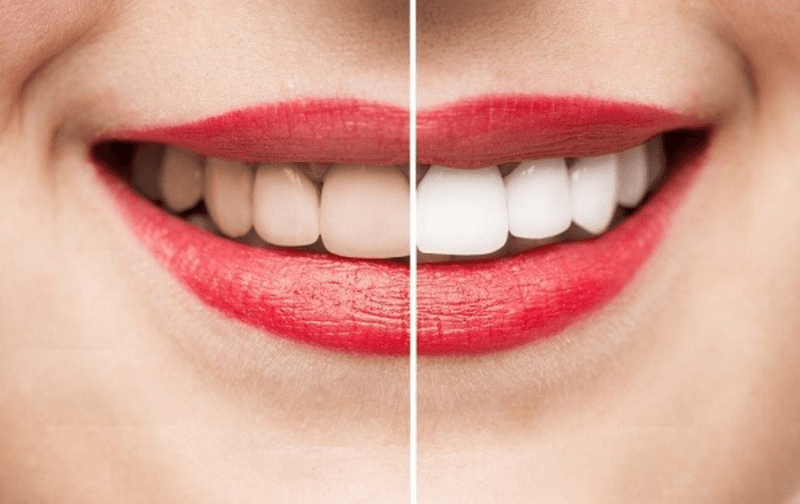 Nguyên nhân gây xỉn màu răng, Các phương pháp tẩy trắng răng và những lưu ý