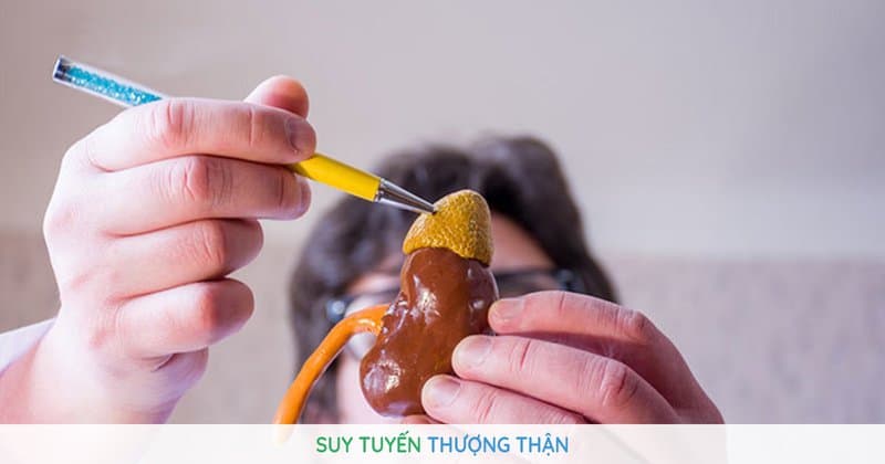 Suy tuyến thượng thận do Lạm dụng corticoid?