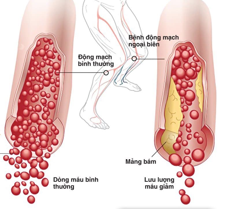 Quy trình chụp cộng hưởng từ động mạch chi trên không tiêm thuốc đối quang từ