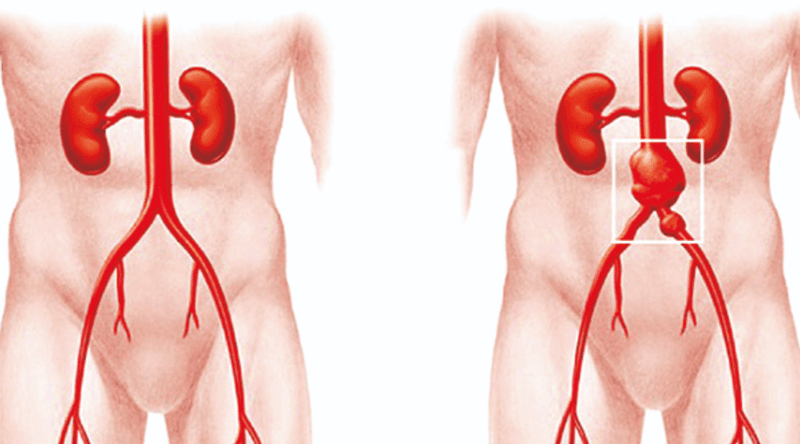 Chụp cộng hưởng từ động mạch chủ chậu có cần thiết không