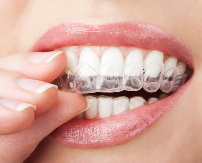 Niềng răng trong suốt có Ưu và nhược điểm gì?