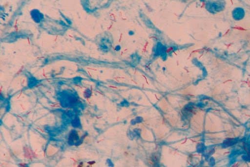 Tìm hiểu Vi khuẩn gây bệnh lao Mycobacterium tuberculosis trên người