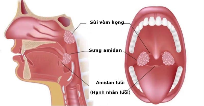 Áp xe quanh amidan: Nguyên nhân, triệu chứng và Chích áp xe quanh amidan