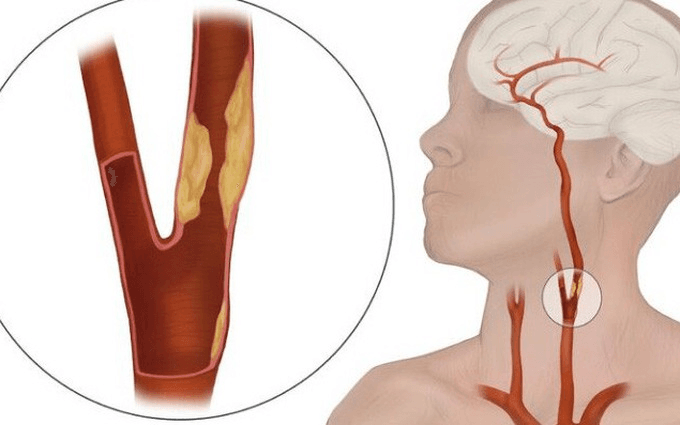 Phẫu thuật thắt động mạch cảnh ngoài: Chỉ định, Quy trình và Theo dõi
