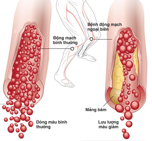 Chụp và điều trị lấy huyết khối cấp tính động mạch chi số hoá xoá nền