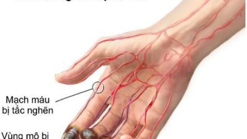 Chụp số hóa xóa nền và tiêu sợi huyết cục huyết khối mạch chi