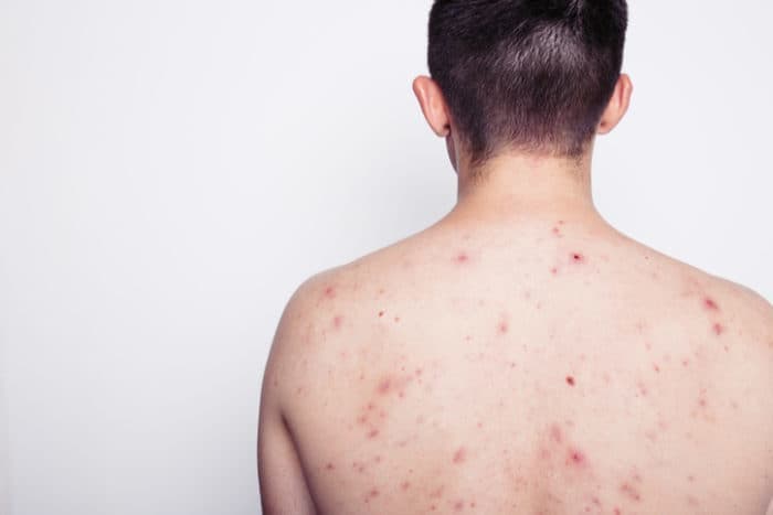 Phát ban HIV: Nguyên nhân, triệu chứng và cách xử lý bệnh