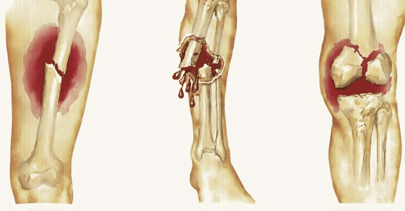 Những yếu tố nguy cơ bệnh ung thư xương