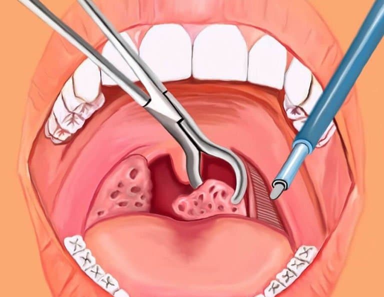 Chảy máu sau cắt Amidan: Cách xử trí, theo dõi