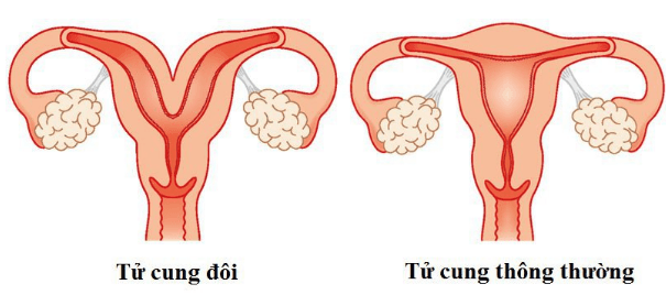 Gây mê nội khí quản phẫu thuật dị dạng tử cung