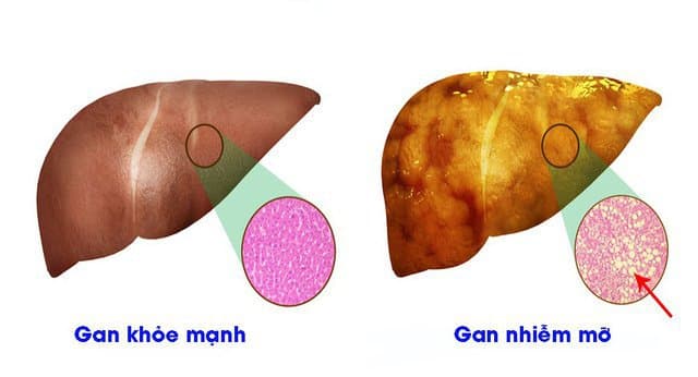Nguyên nhân khiến người cao tuổi dễ mắc gan nhiễm mỡ