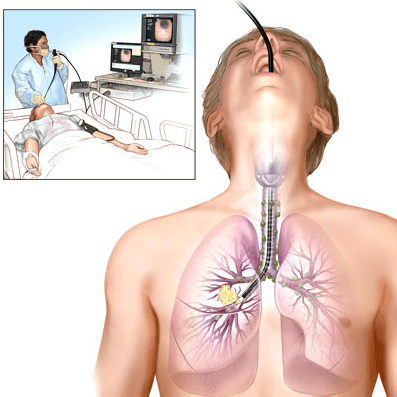 Nội soi phế quản sinh thiết: Những điều cần biết