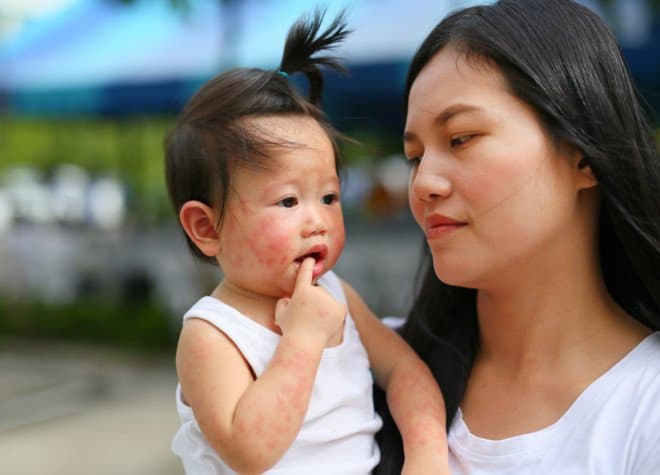 Xử trí bệnh tay chân miệng độ 1 theo hướng dẫn của Bộ Y tế