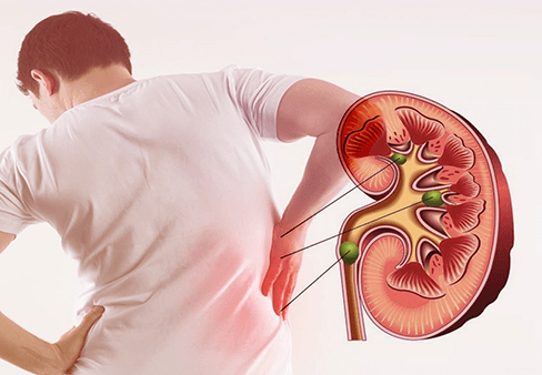 Sỏi thận là bệnh gì? triệu chứng, chuẩn đoán và điều trị