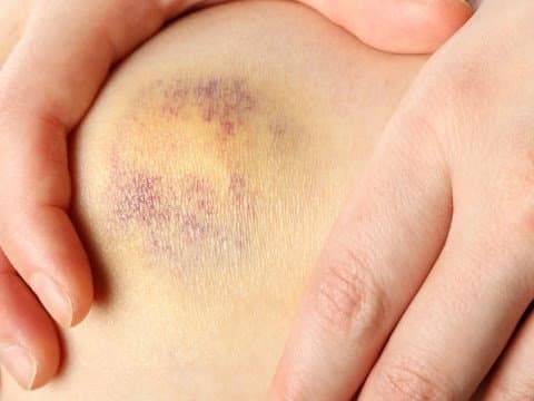 Giảm tiểu cầu do dùng thuốc