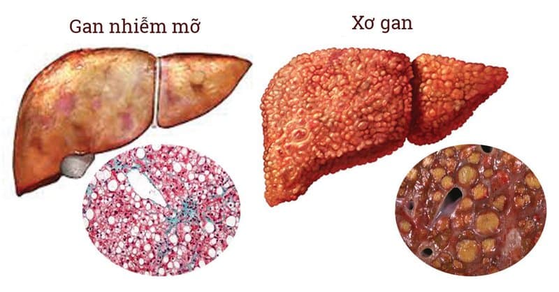 Trẻ em bị gan nhiễm mỡ có nguy hiểm không?
