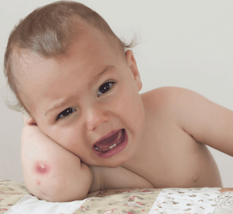 Trẻ bị nhọt và cách chăm sóc