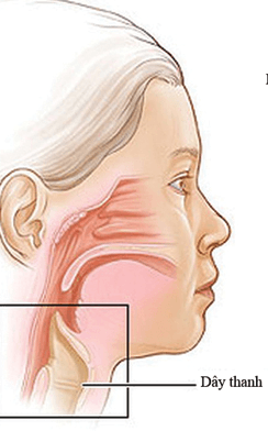 Phẫu thuật cắt thanh quản toàn phần