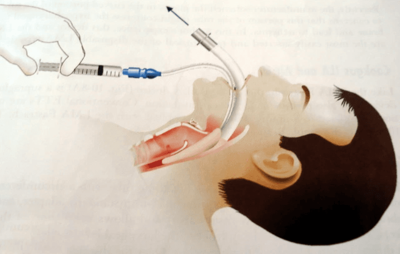 Quy trình gây mê mask thanh quản phẫu thuật đặt khung định vị não
