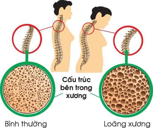Những điều cần biết về bệnh loãng xương