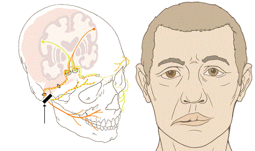 Quy trình gây mê mask thanh quản cắt toàn bộ tuyến mang tai, bảo tồn dây thần kinh số