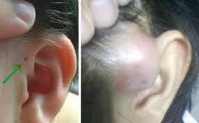 Gây mê mask thanh quản cắt đường rò luân nhĩ
