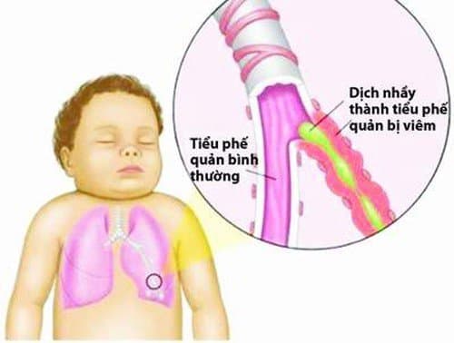 Triệu chứng viêm phế quản co thắt ở trẻ