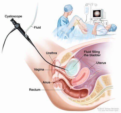 Lưu ý quan trọng với người bệnh được đặt Sonde JJ