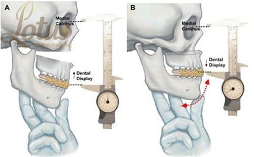 Điều trị gãy lồi cầu xương hàm dưới do chấn thương