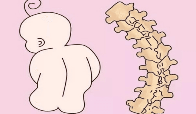 Triệu chứng cong vẹo cột sống ở trẻ em