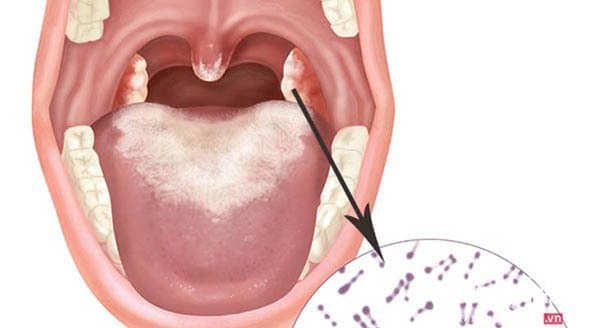 Bạch hầu là bệnh gì, Tại sao bạn bị bệnh bạch hầu?