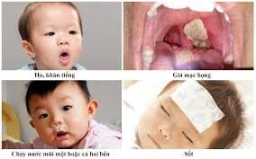 Bạch hầu thanh quản ở trẻ em