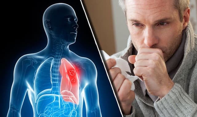 Phân biệt ho do ung thư phổi và bệnh thông thường