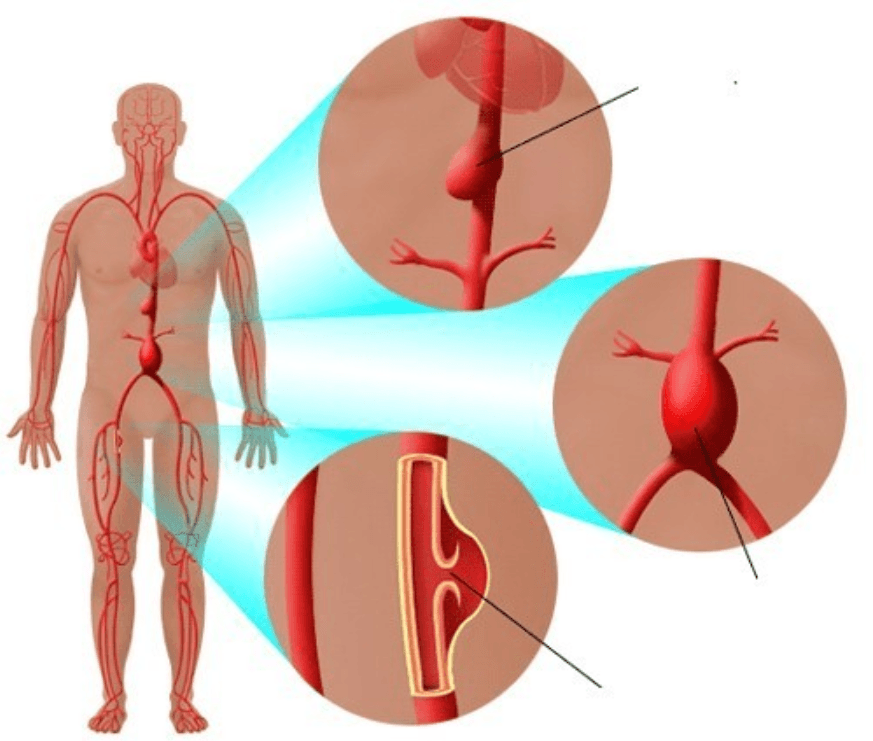 Phẫu thuật nội soi điều trị phồng, tắc, hẹp động mạch chủ bụng dưới thận