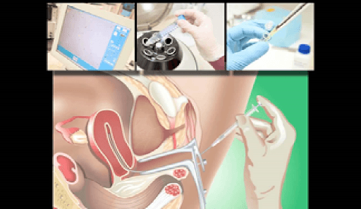 Kỹ thuật bơm tinh trùng vào buồng tử cung (IUI)